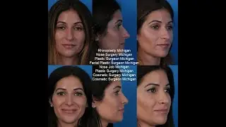 Facial Plastic Surgery Michigan  | Facial Plastic Surgeon  | Rhinoplasty Michigan