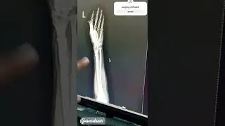 Hand fracture, Forearm Plaster, Wrist Plaster #doctor