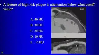 11 CAD RADS 2.0, complications of ischemia and infarction