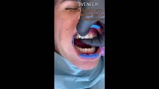 Iveneer インジェクタブル マトリックス