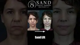 What to Expect During a Facelift Consultation | Sand Plastic Surgery