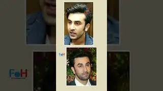 🔥Bollywood actors hair transplant #Akshaykumar#SunnyDeol#KapilSharma #hairtransplantsurgery#Shorts