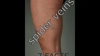 Spider Veins   7 Facts About Leg Spider Veins You Must Know