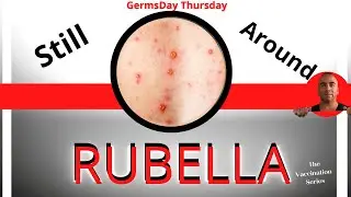 RUBELLA | German measles | 3 Day Measles ??? What are those??????