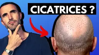 GREFFE DE CHEVEUX : EST CE QUE LA TECHNIQUE FUE FAIT DES CICATRICES?
