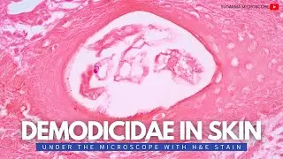 Demodicidae in skin under the microscope with Haematoxylin and Eosin (H&E) stain