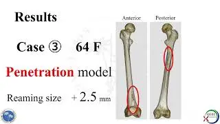 Finite element analysis of femur strength after Reamer Irrigator Aspirator (RIA)