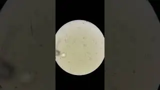 schistosoma haematobium in urine