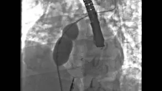 Device closure of the smaller of the fenestrated Ostium Secundum atrial septal defect