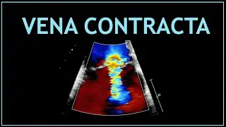 VENA CONTRACTA! (Ecocardiografia)