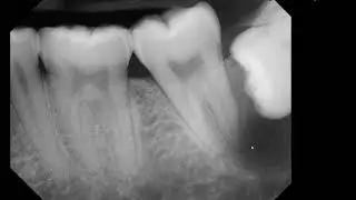 Pericoronal radiolucy #17 on PA