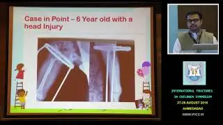 Dr Swapnil Keny - Fracture Shaft Femur in Children - Spica