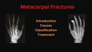 Fractures of the Metacarpals | Fracture in athletes | Metacarpal head, neck, shaft & base fracture