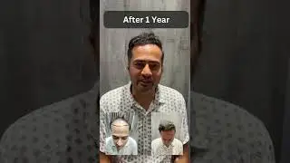 Mr. Brijesh Patel's Testimonial - Hair Transplant Treatment at Advance Hair India