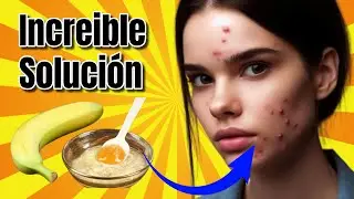 Como DESAPARECER GRANOS de la CARA Rapido Quitar Acne del Rostro Naturalmente 2025