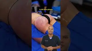 The Magic of BBL Explained by Dr. Brewster
