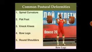 POSTURE DEFORMITIES
