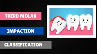 Third Molar Impaction Classification -Surgery