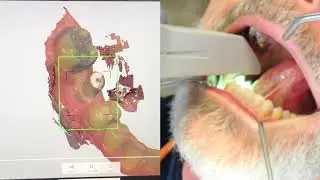 Trios Scan of Elos Scan Body for a Molar Implant