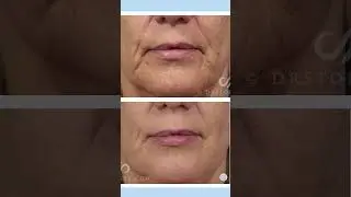 Before & After Fractional CO2 Laser Treatments