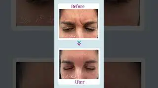 Botox. Before & After