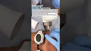Revolutionary Fotona Skin Tightening: Boost Elasticity & Reduce Wrinkles in Dubai