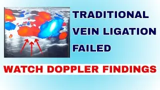 This Recurrent Varicocele Video is for Urology Doctors ـ Traditional Vein Ligation Failed .