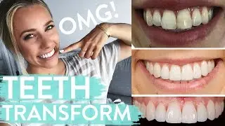TEETH TRANSFORMATION | Porcelain Veneers | Before & After + Review