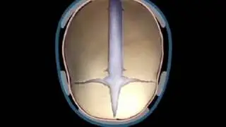 Sagittal Synostosis  Helmet Therapy - Craniosynostosis Surgery