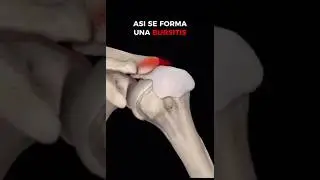As&iacute; se forma una BURSITIS #fisio #hombro #recuperaci&oacute;n #recovery
