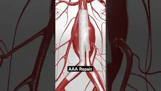 Укрепление слабой аорты для предотвращения разрыва (3D-анимация)