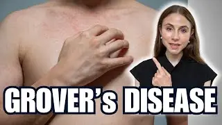 Grover&rsquo;s Disease: Dermatologist&rsquo;s Guide to the Itchiest Skin Rash