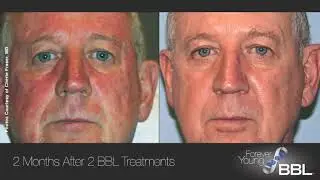 Forever Young BBL Testimonials | Laser and Skin Surgery Center of Indiana