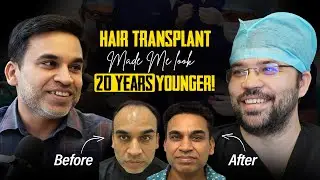 Hair Transplant: Cost, Recovery & Real Patient Experience | Grade 6 Baldness Treatment | Skinroots