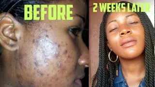 How To Fade Acne Scars Fast Naturally In 2 Weeks / Julia Beauty
