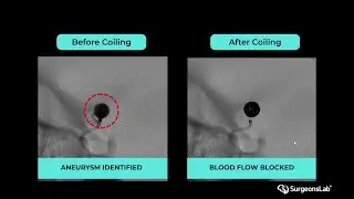 Aneurysm Coiling & Catheterization Training | Left M1 Segment on CathTrain VR