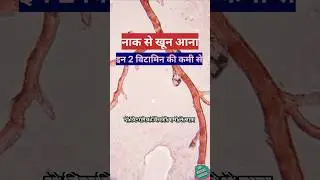 Nose Bleeding इन दो Vitamin की Deficiency से होती है #shorts #nosebleed #drstethohealth