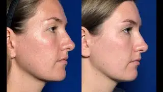 TCA peeling voor een egale en gladdere huid uniek toegepast
