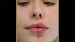 Lip Filler Injections At Skin Science Clinic