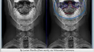 Trauma Assessment - C-Spine Rule and CT Head Rule