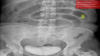 Evaluation of bilious emasis in neonate in Dari