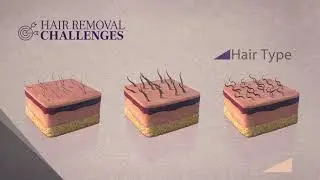 SHR 3D Technology  - Soprano laser hair removal