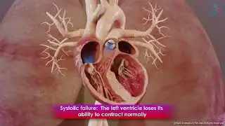 Heart Failure - Symptoms, Causes, and Treatment (Animation)