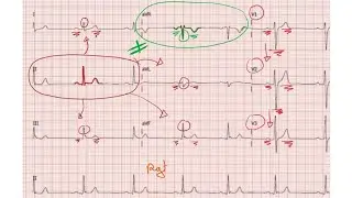 ECG de A à Z : Les ondes PQRST prt 2