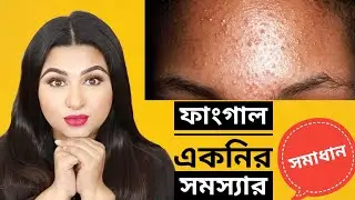 ফাংগাল একনি কি? 2019 | ফাংগাল একনি দূর করার উপায় - Fungal Acne Safe Products || Ananya Artistry