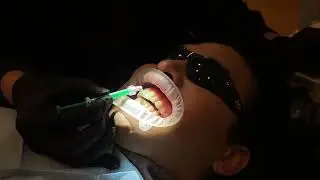 Icon Resin Infiltration System - Vitality Dental - Dentist Plano
