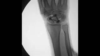 Capitate Wedging X-Ray