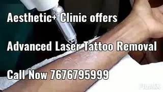 Advanced Tattoo Removal Bangalore Call now 7676795999