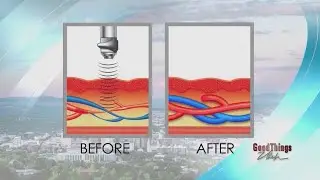 Acoustic Wave Therapy helping couples get their groove back in the bedroom