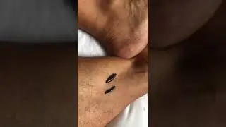 Leg & Ankle Leech Therapy procedure. Medical leeches 4 diabetes, varicose veins, leg, thigh pressure